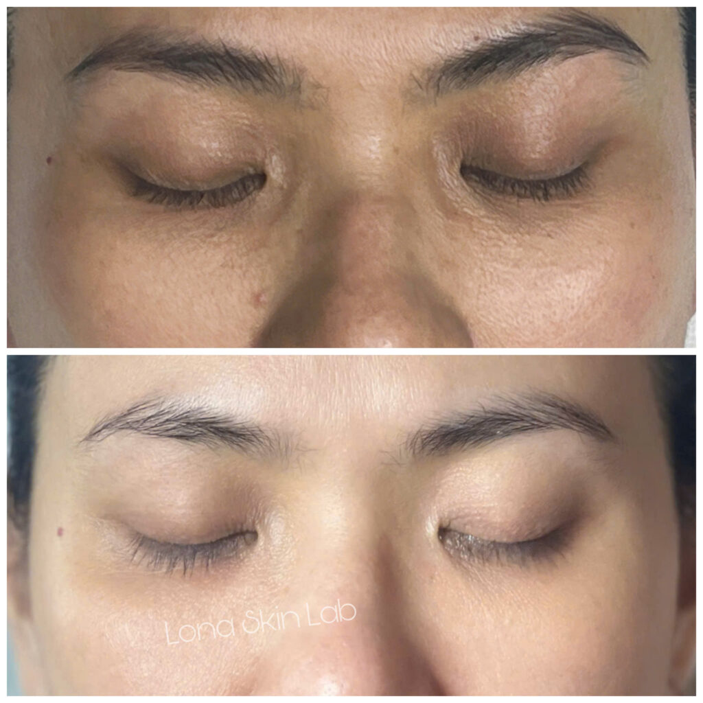 Kết quả điều trị mụn tại Cần Thơ được chứng minh qua sự hài lòng của khách hàng và đội ngũ chuyên gia hàng đầu.