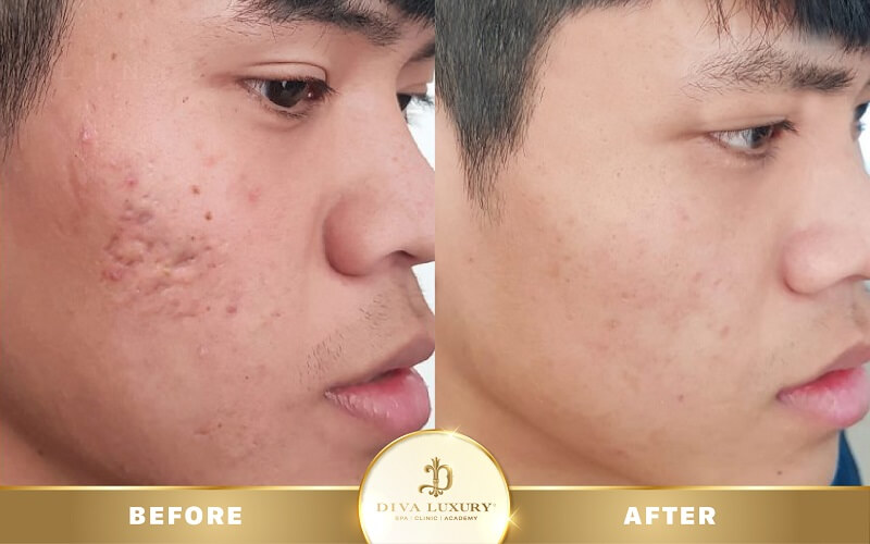 trị sẹo rỗ Long Xuyên tại DIVA Luxury, địa chỉ uy tín
